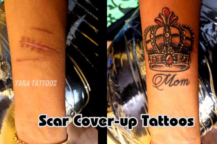 Before and after transformation of a scar cover-up tattoo by Yaara Tattoos in Coimbatore, showcasing a beautifully designed crown and 'Mom' text. Expert scar cover-up tattoo service in Coimbatore to help clients regain confidence through art. Discover customized scar cover-up solutions at Yaara Tattoos.