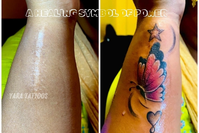 Before and after scar cover-up tattoo by Yaara Tattoos in Coimbatore, transforming a scar into a colorful butterfly and heart design. This healing symbol of power and beauty reflects our expertise in creating meaningful, personalized tattoo art. Visit Yaara Tattoos in Coimbatore for custom scar cover-up tattoos